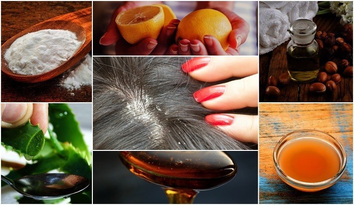 Best Home Remedies to Remove Dandruff!