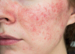 Sensitive Skin